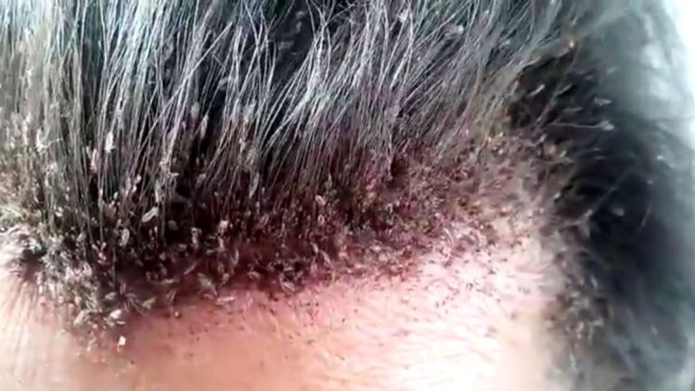 cara agar kutu rambut hilang
