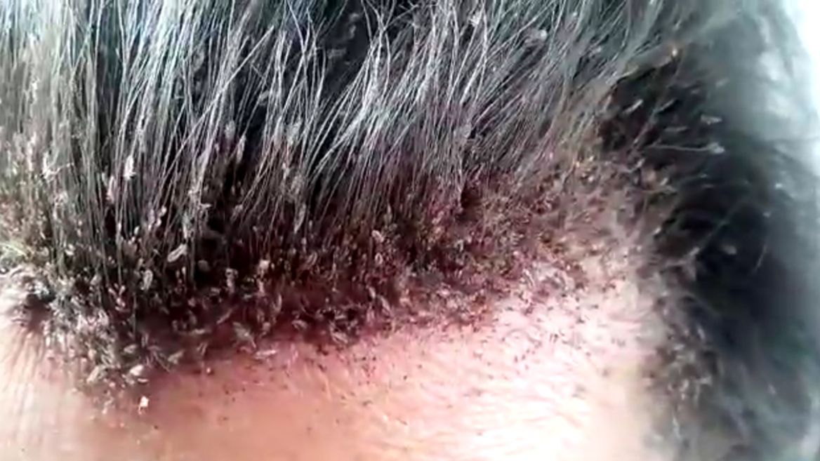 cara agar kutu rambut hilang