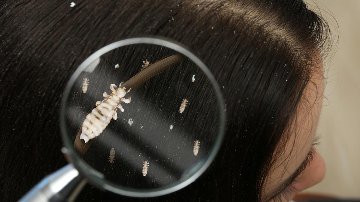 cara agar kutu rambut hilang