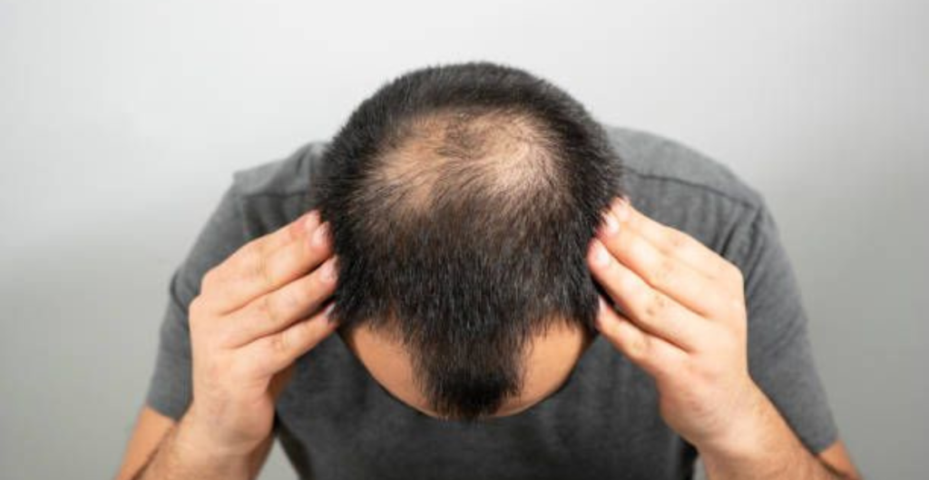 Cara Cepat Menumbuhkan Rambut