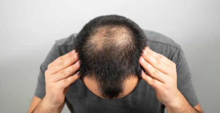 Cara Cepat Menumbuhkan Rambut